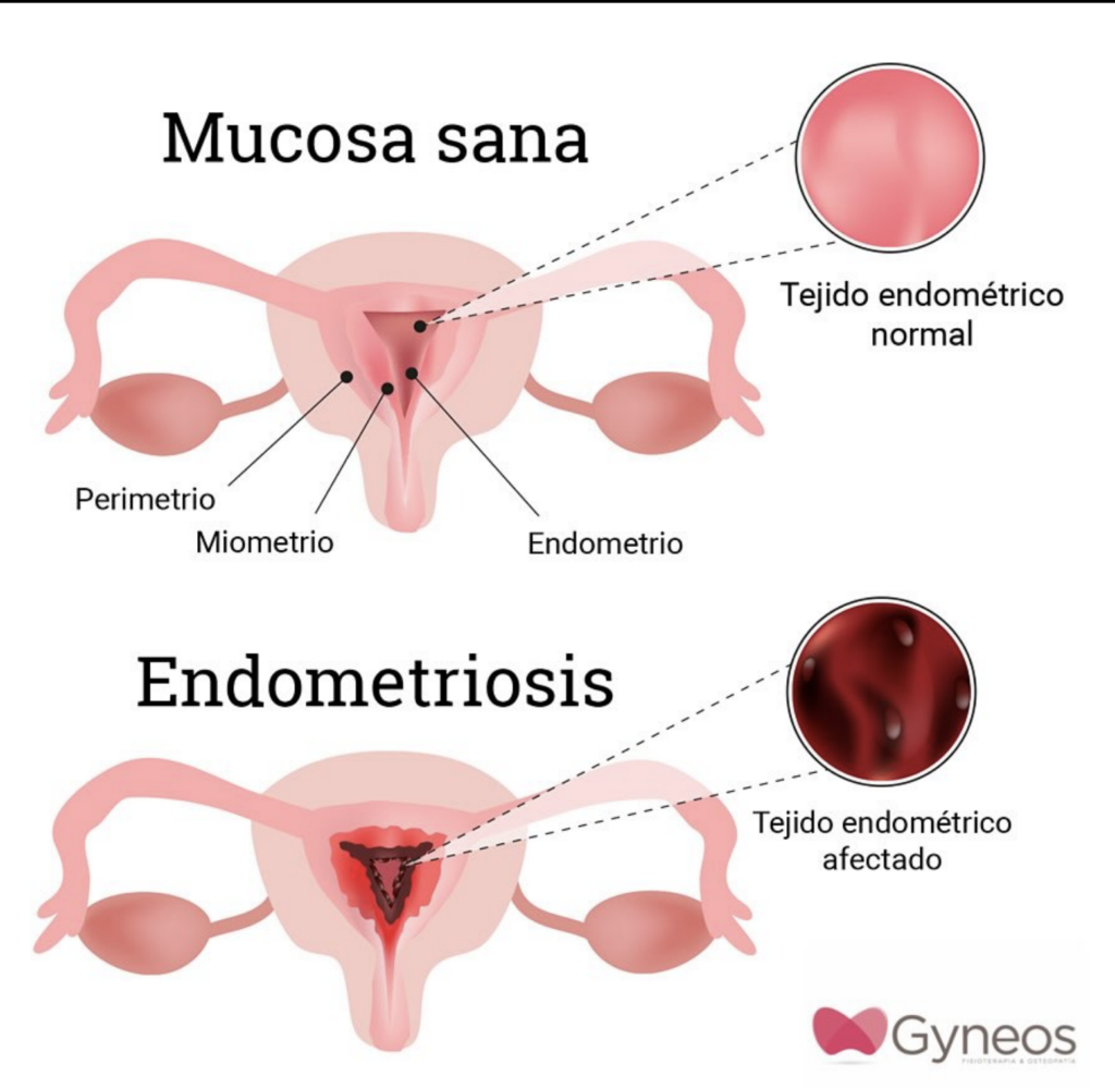 endiometrosis