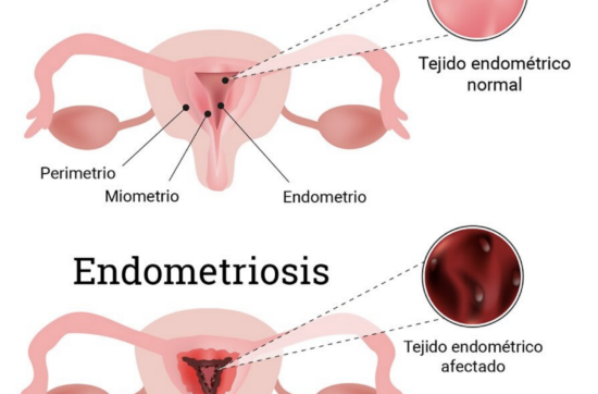 endiometrosis